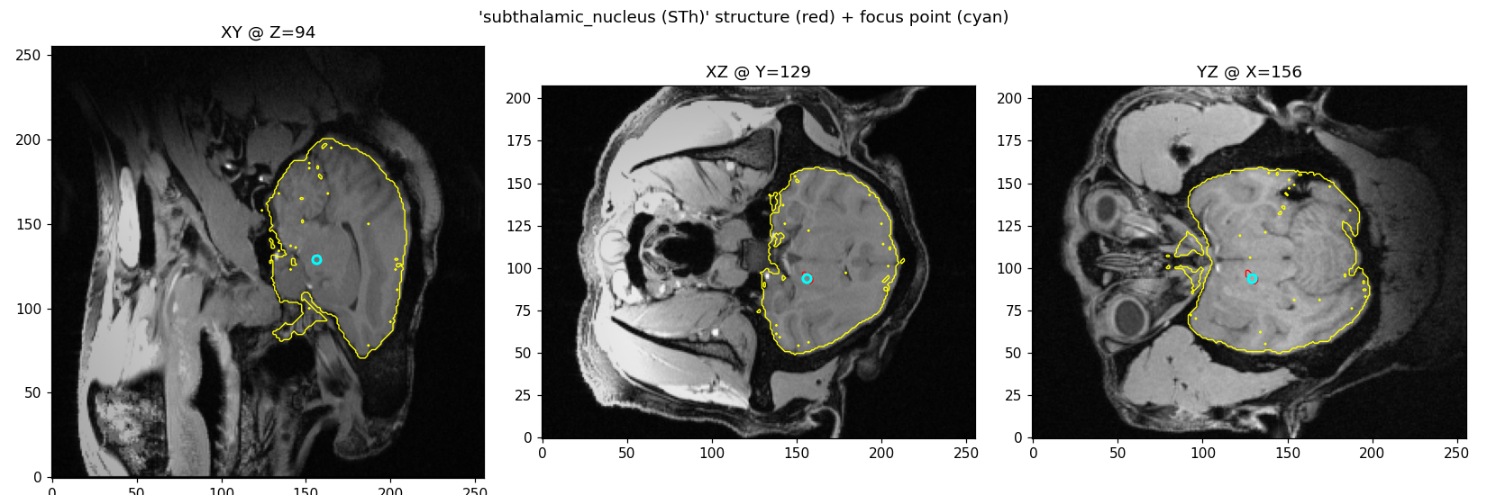 MRI slices in three planes with the subthalamic nucleus outlined and the planned focus point marked